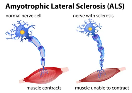 conceito de esclerose lateral amiotrófica
