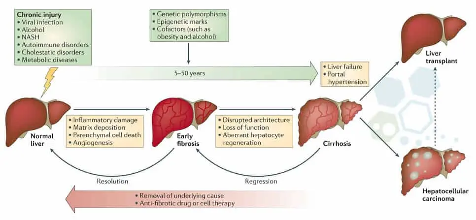 Um gráfico mostrando o progresso dos pacientes antes e depois do tratamento com células-tronco para doenças hepáticas