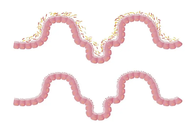 Transplante de Microbiota humana (FMT)