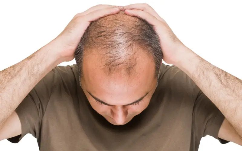 O Potencial da Terapia com Células-Tronco para Queda de Cabelo