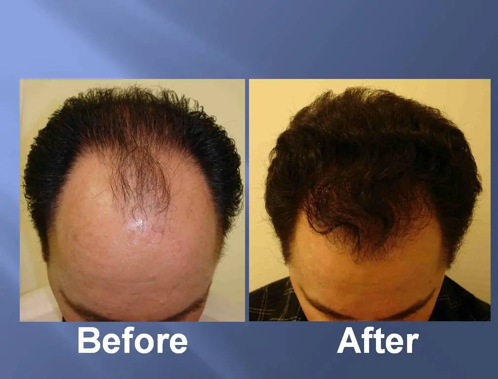 Imagens de antes e depois da restauração capilar usando terapia com células-tronco